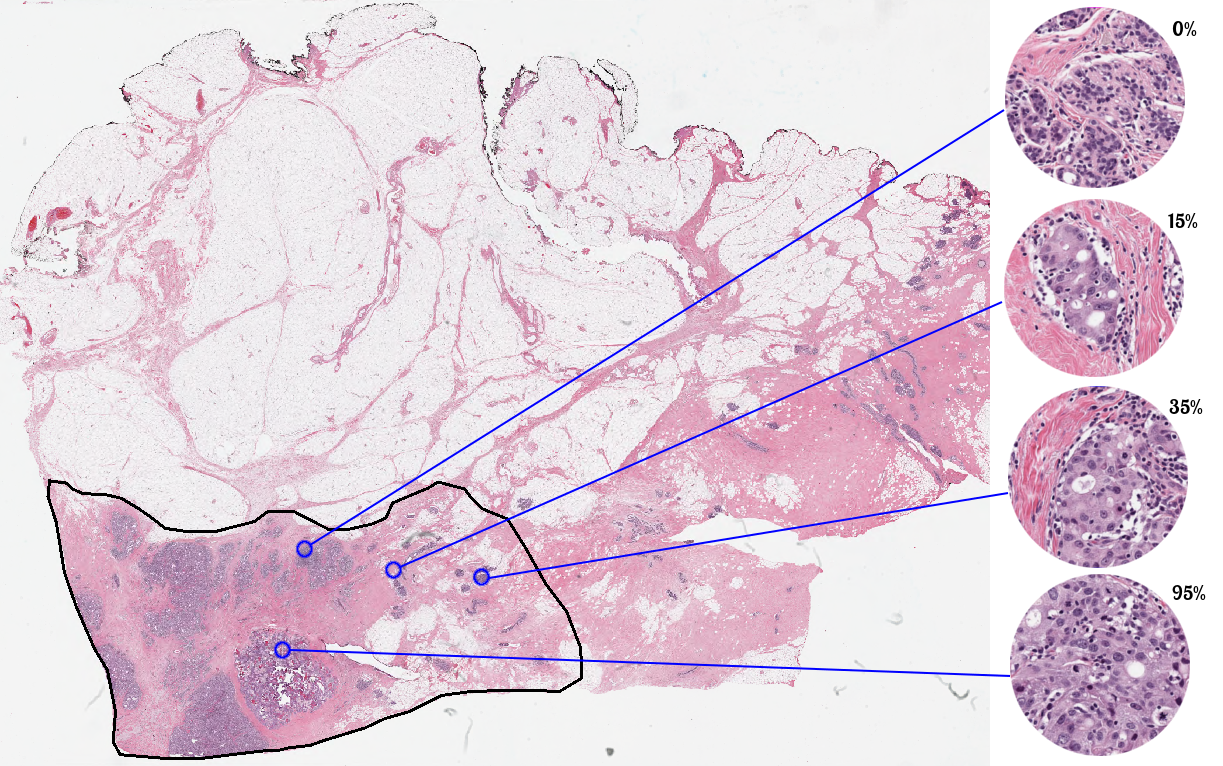 BreastPathQ: Cancer Cellularity Challenge 2019 – Medical Imaging